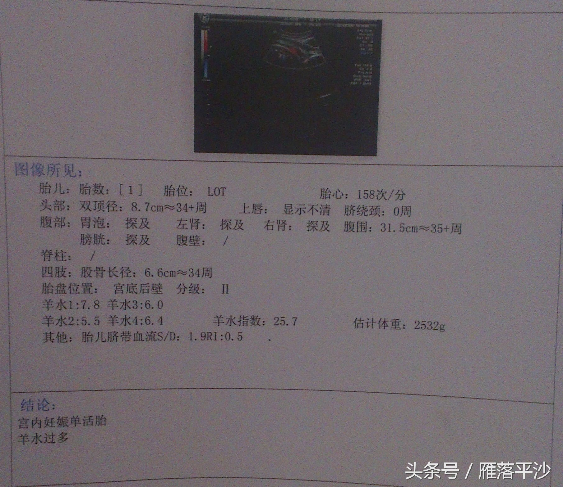 孕期羊水多对胎儿有危险吗,孕33周羊水过多胎儿畸形概率