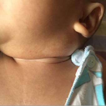 婴儿湿疹和奶粉过敏湿疹怎么区别,宝宝湿疹治疗有效的方法