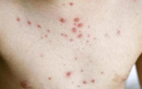 顽固性湿疹的民间秘方,皮肤病湿疹止痒秘方