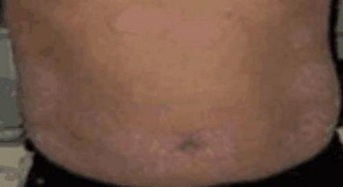 顽固性湿疹的民间秘方,皮肤病湿疹止痒秘方