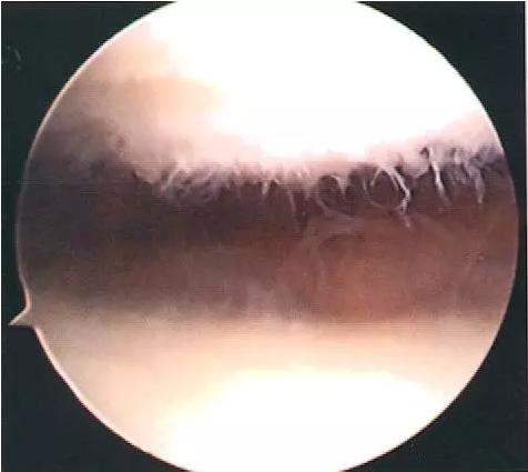 不能轻视的膝关节运动损伤：髌骨软化症