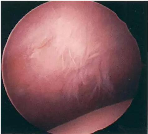 不能轻视的膝关节运动损伤：髌骨软化症