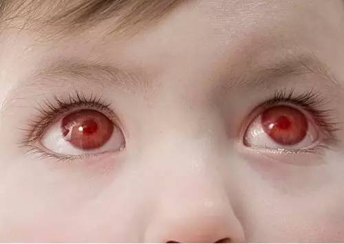 游泳眼睛红预防,游泳后点眼药水预防眼病对吗