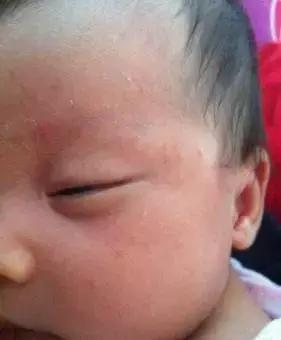 婴儿患湿疹怎么治疗,为什么普遍婴儿都得湿疹