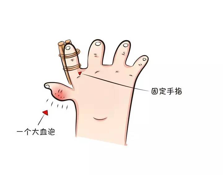 啊呜，宝宝手指被夹了
