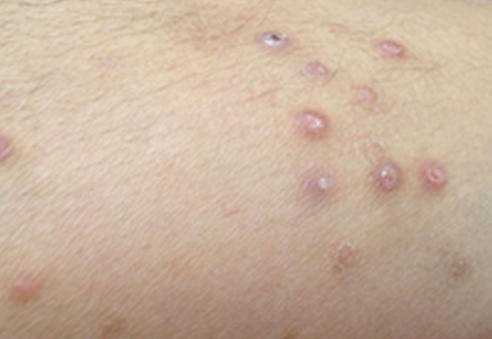 顽固性湿疹的民间秘方,皮肤病湿疹止痒秘方