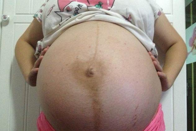 250斤孕妇怀孕,孕妇怀孕双胞胎6个月