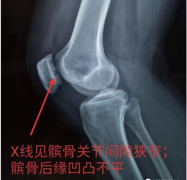 不能轻视的膝关节运动损伤：髌骨软化症