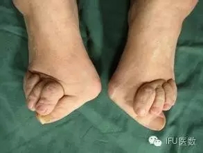 骨科杨茂伟,足部风湿性关节炎