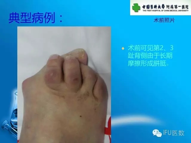 骨科杨茂伟,足部风湿性关节炎