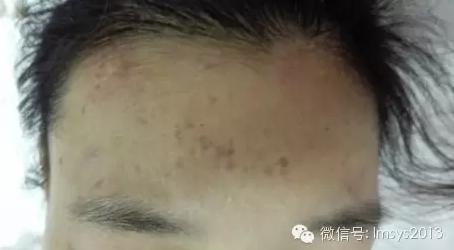 中医火针疗法治疣,中医实战笔记扁平疣秘方