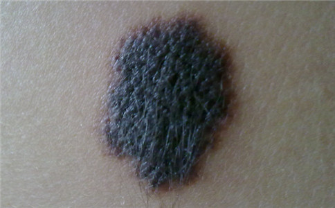 孙红雷曾说：得了黑痣赶紧点，千万别以为是好运和性感！真的吗？