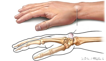 治疗腱鞘囊肿的特效方子真灵验,怎么自己在家捏爆腱鞘囊肿