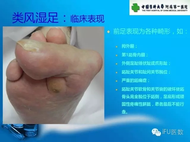 骨科杨茂伟,足部风湿性关节炎