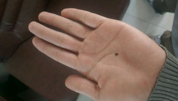 孙红雷曾说：得了黑痣赶紧点，千万别以为是好运和性感！真的吗？