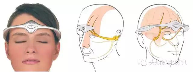 电疗头痛仪,头痛用低频电子治疗仪