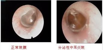 如何治疗分泌性中耳炎,分泌性中耳炎能自愈吗