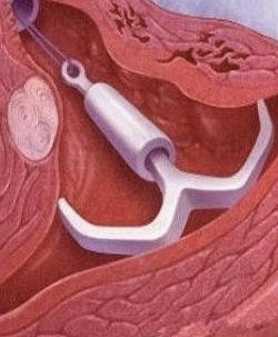 男人，如果你爱你的女人，就别让她上环！