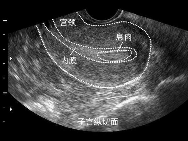 子宫内膜息肉怎么阻止它不长,怎样才能让子宫内膜息肉不复发呢