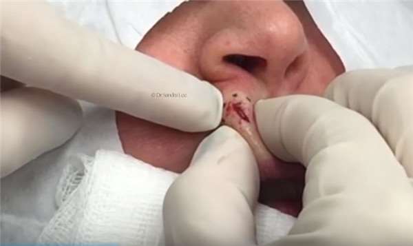 医生从她人中上的不明肿瘤一刀切下去后，这东西竟然蹦出來！慎入