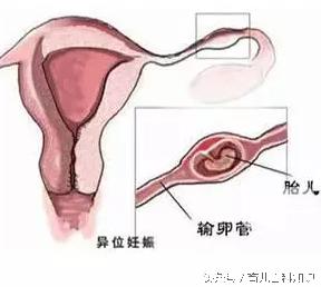 一般100个孕妇里面有几个宫外孕,100个人里面有几个会得宫外孕呢
