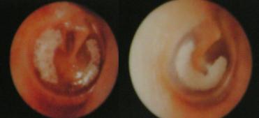 如何治疗分泌性中耳炎,分泌性中耳炎能自愈吗