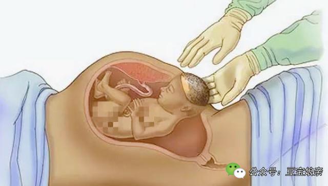 剖腹产医生手要伸进肚子里吗,剖腹产后男医生按压肚子