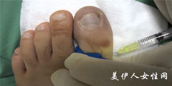 脚突然就出汗发臭,脚没烂不痒却散发出臭味