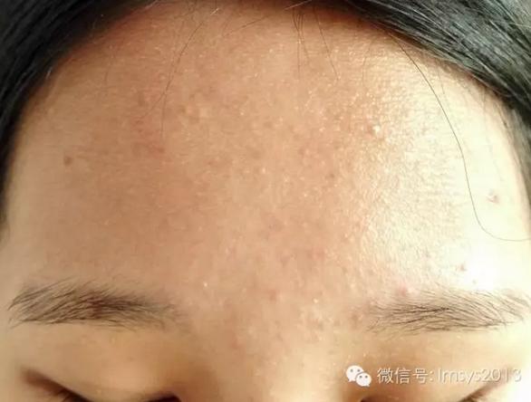 中医火针疗法治疣,中医实战笔记扁平疣秘方