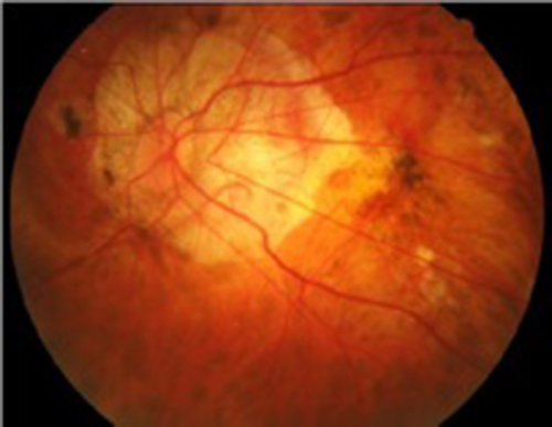 高度近视的孕妇可以顺产吗,视网膜脱离病史妈妈可以顺产吗