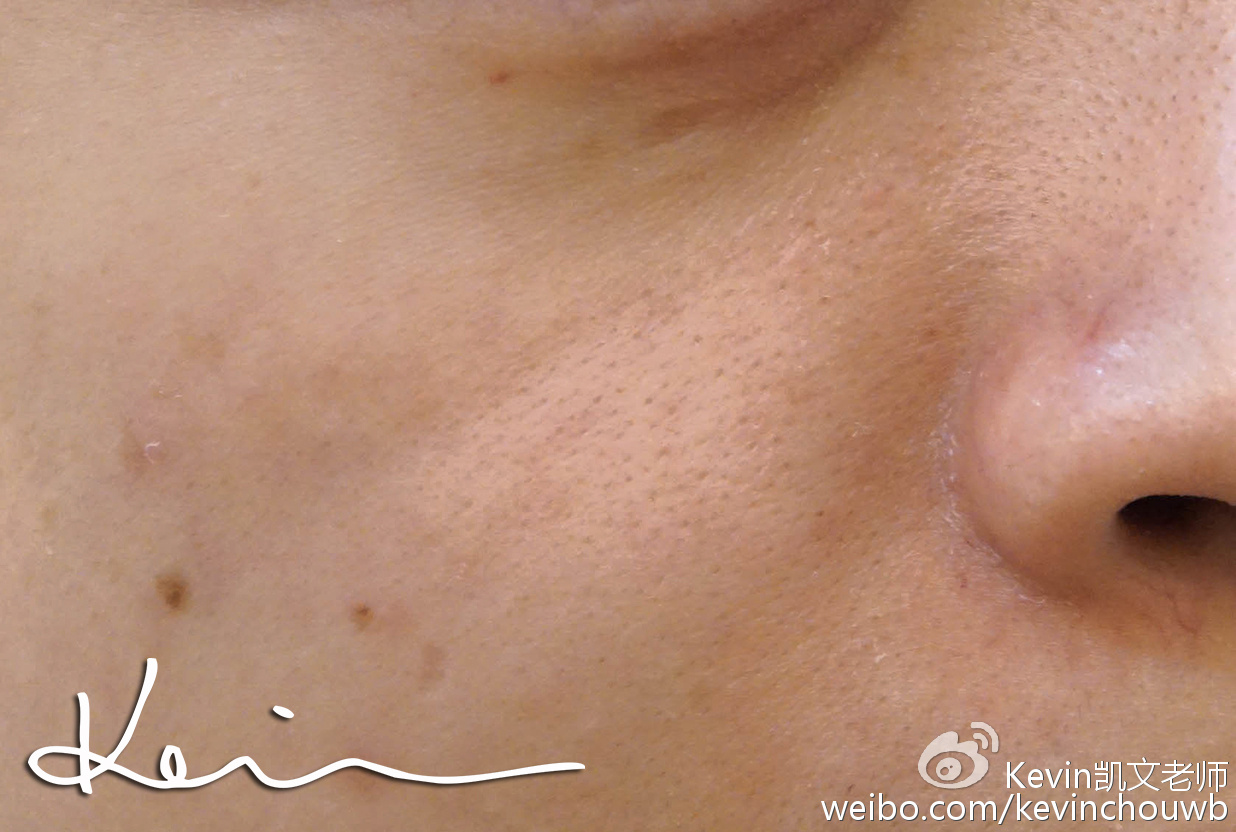 痘痘黑头粉刺用什么化妆品,痘痘粉刺黑头用什么化妆品