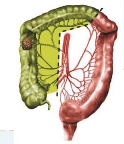 胆囊切除手术后发现结肠癌,胆囊切除后发现食管癌