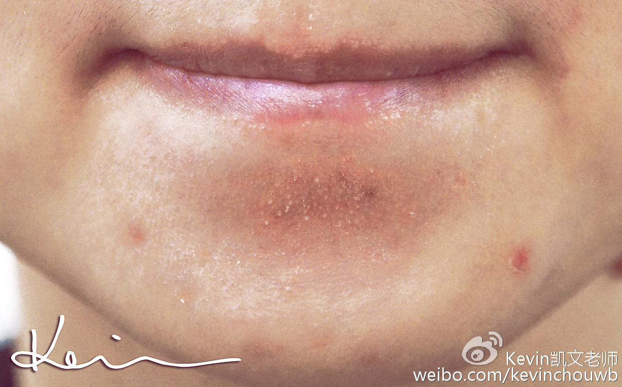 痘痘黑头粉刺用什么化妆品,痘痘粉刺黑头用什么化妆品