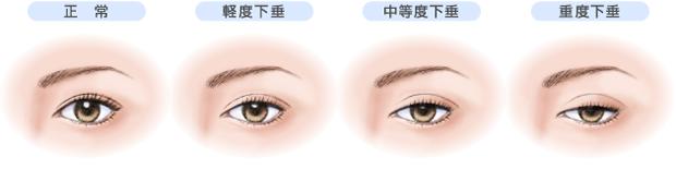 重度上睑下垂矫正方法,如何选择上睑下垂手术时机