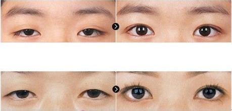 重度上睑下垂矫正方法,如何选择上睑下垂手术时机