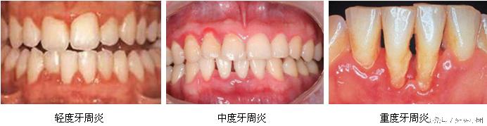 牙周炎可以洗牙解决,牙周炎严重能洗牙吗