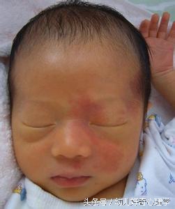 为什么有些婴儿会有胎记,为什么有的婴儿会有胎记