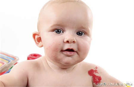 为什么有些婴儿会有胎记,为什么有的婴儿会有胎记