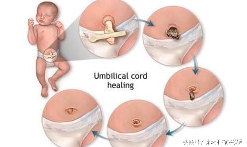 脐带掉了后怎么护理可以用碘伏嘛,怎么给0-7天的宝宝脐带消毒护理