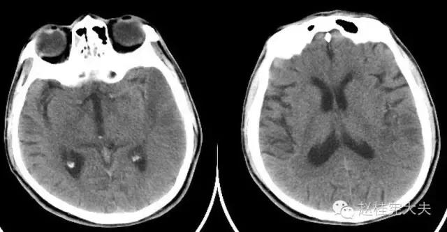 脑卒中简单科普,年轻人是不是不要担心脑卒中