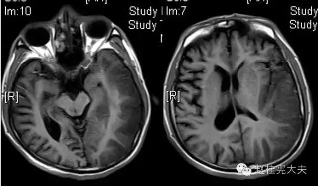 脑卒中简单科普,年轻人是不是不要担心脑卒中