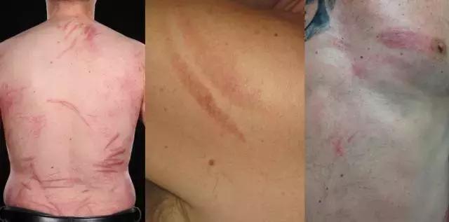巴西男子身上莫名出现多处“鞭”痕，只因做了这件事...