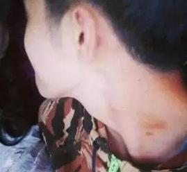 男孩被女友留吻痕丧命,男子和女友接吻差点死亡