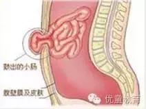 如何正确的预防小儿疝气,小儿疝气是什么原因引起的