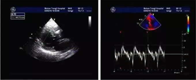 心力衰竭治疗要点的思维导图,心力衰竭疑难病例讨论记录模板