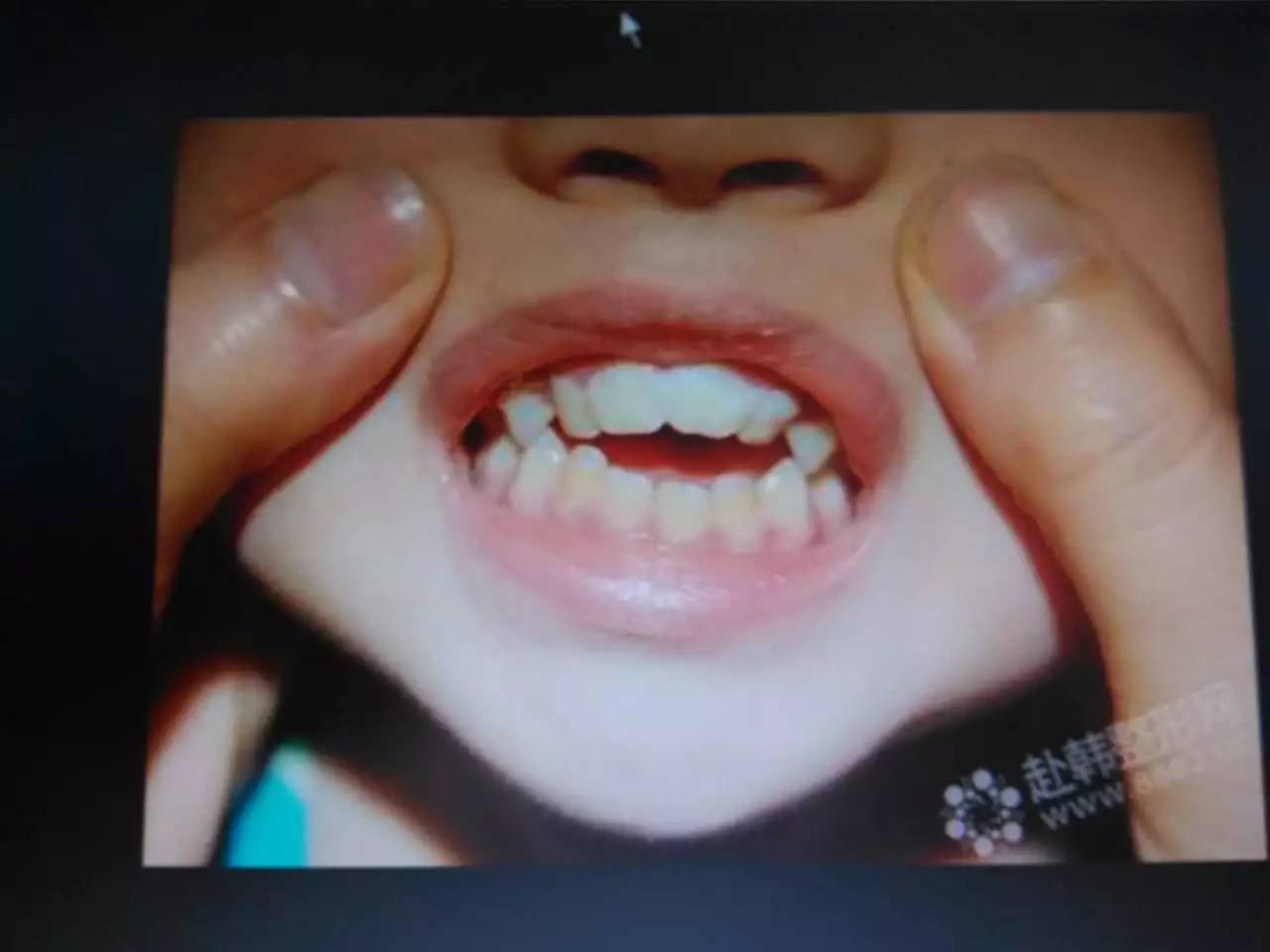 讲解换牙视频,换牙科普知识幼儿园