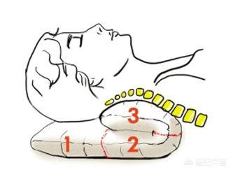 年轻人颈椎反弓什么症状,颈椎反弓年轻人