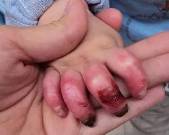 如果你不谨慎被烫伤了怎么办,烫伤之后你该怎么做