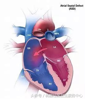 心脏支架说明书,这份通俗易懂的心脏说明书请收好
