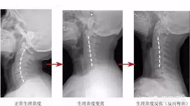 年轻人颈椎反弓什么症状,颈椎反弓年轻人